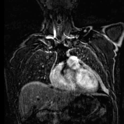 Cardiac MRI - Exeter Heart