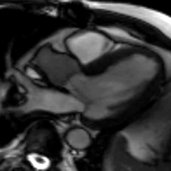 MRI heart valves 1