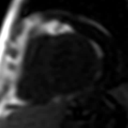 Blood flow into the heart muscle can be assessed through MRI perfusion scanning